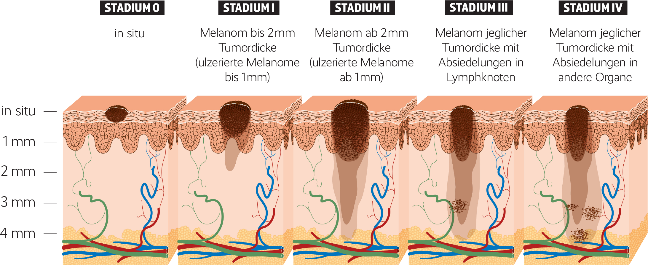 Melanom GemeinsamGesund.novartis.at